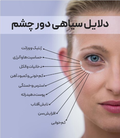 چرا دور چشممان تیره میشود؟ بررسی جامع دلایل سیاهی و گودی زیر چشم